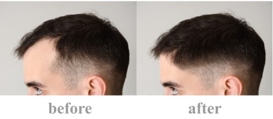 Before and after photos of hair regrowth in male